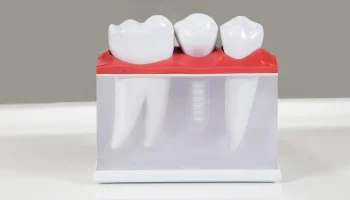 Are Dental Implants Painful? What Patients Should Expect