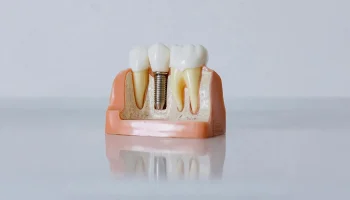 Why Is My Dental Implant Loose? Could It Be Failing?
